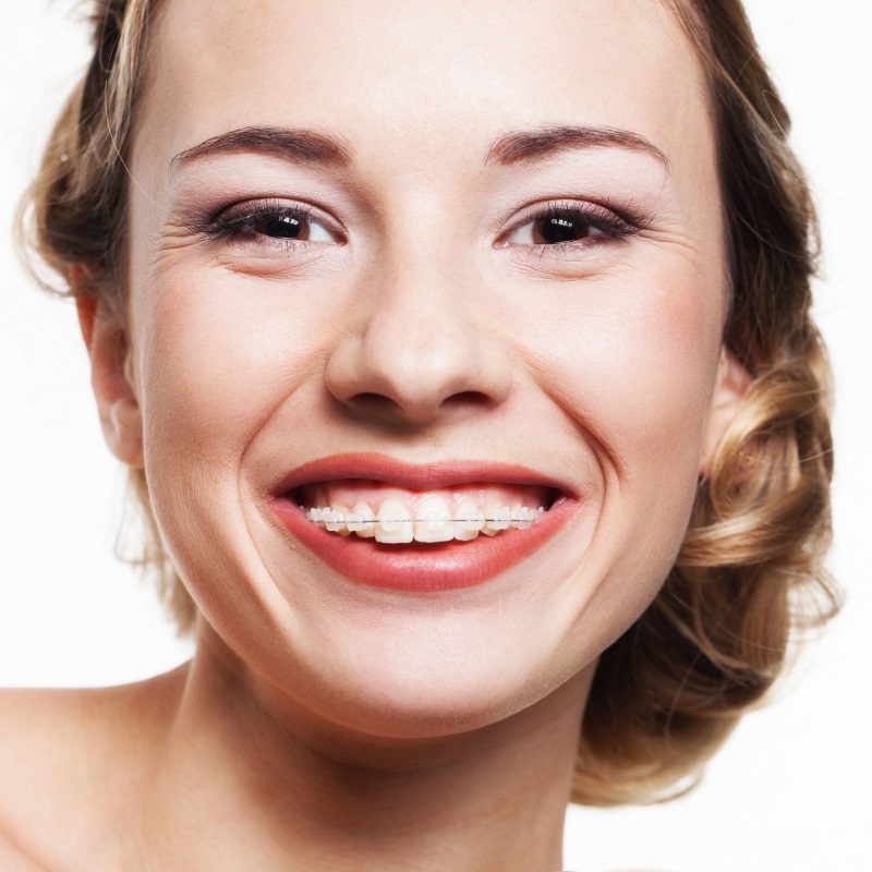 Clear Ceramic Cosmetic Braces in Carlisle from York Place Dental