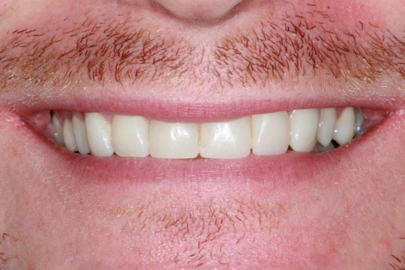 After Cosmetic Bonding Dental Treatment by York Place Dental