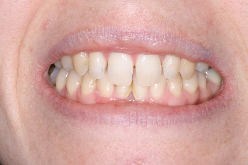 Before Cosmetic Bonding Dental Treatment by York Place Dental