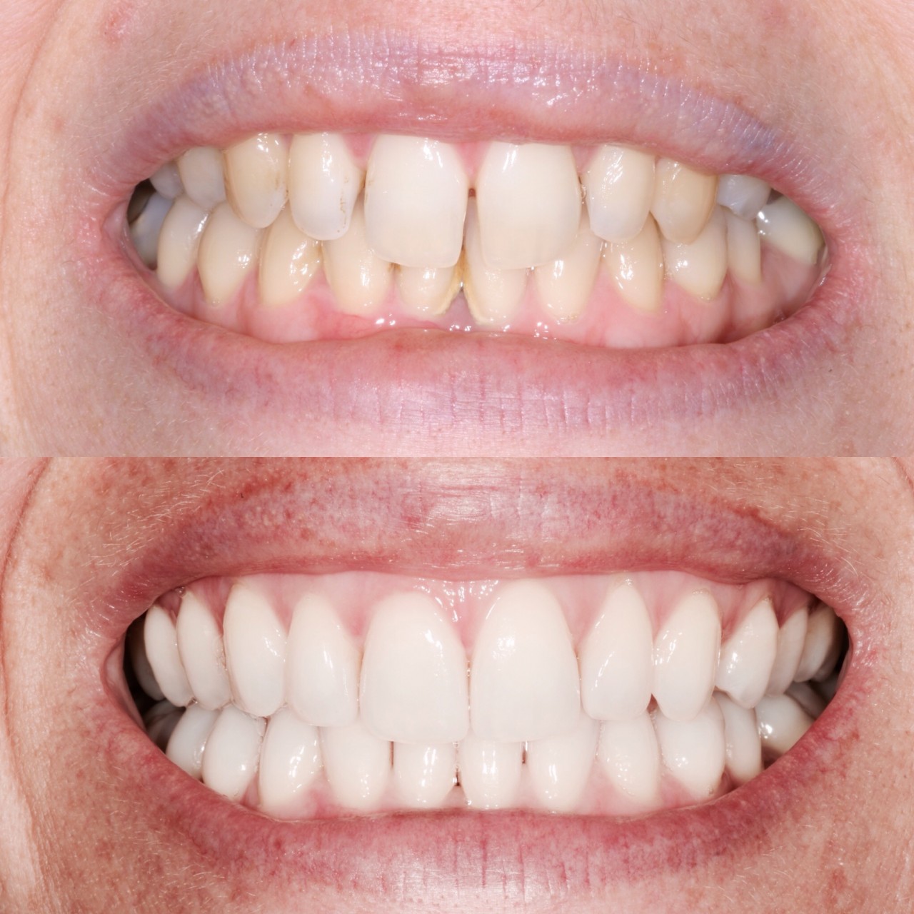 Cosmetic-Bonding-Before-After