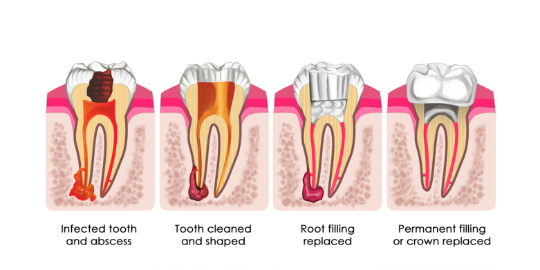 Root-Canal-Process-781x391