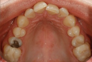 Secret Smile 1 teeth before lingual braces treatment
