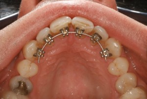 Secret Smile 3 migration of misaligned tooth complete