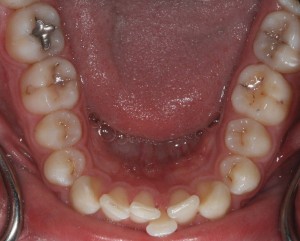 Crowded lower teeth
