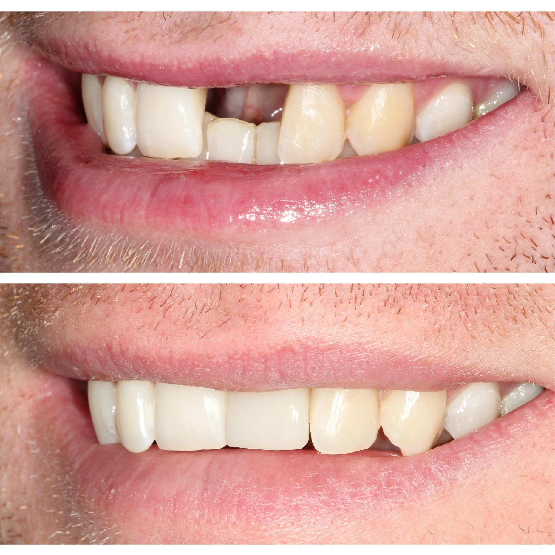 Before and after single dental implant replacing a missing front tooth at York Place Dental, Carlisle.