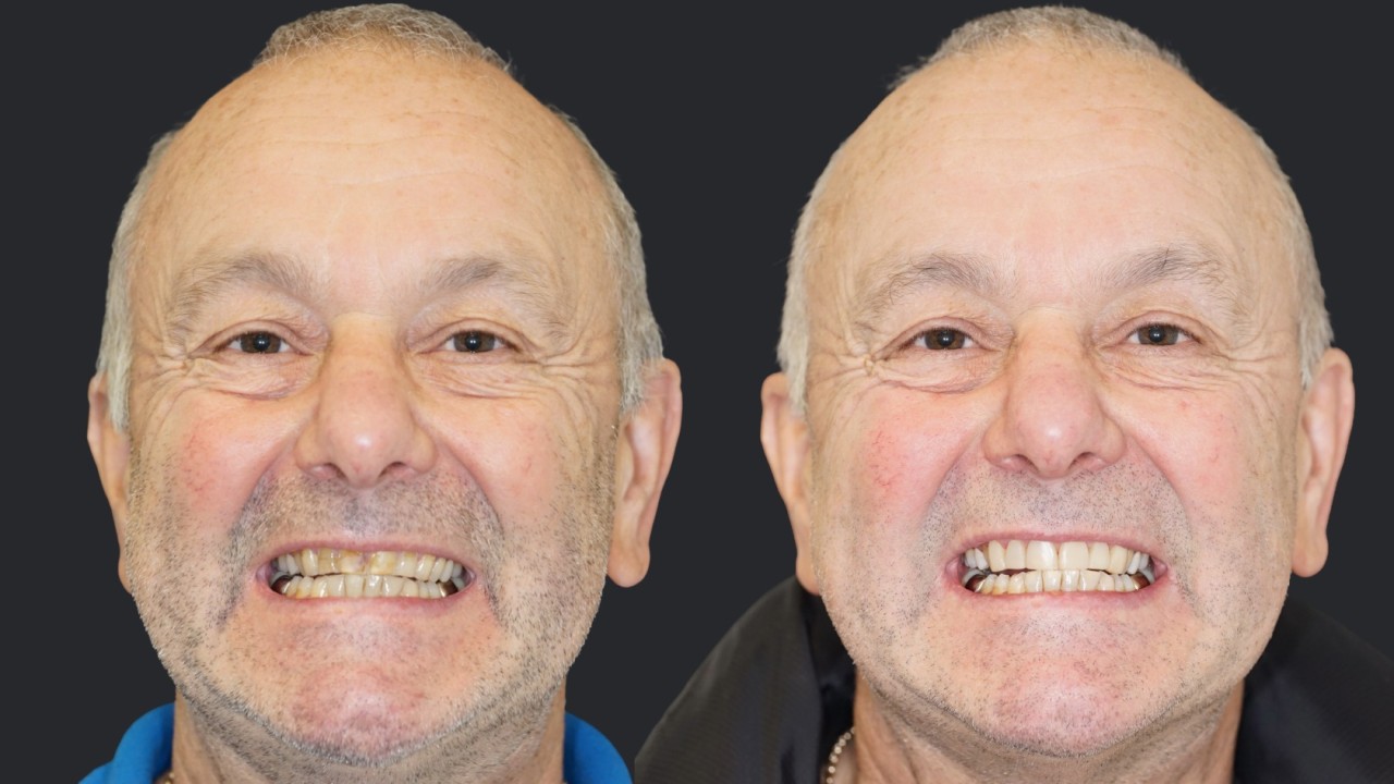 Composite Bonding in Carlisle: Transform Your Smile with a Subtle, Natural Finish